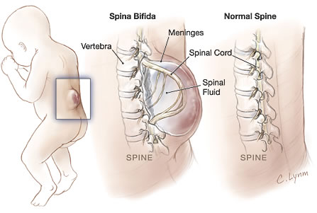spina bifida, set hamil shaklee, vitamin semasa mengandung